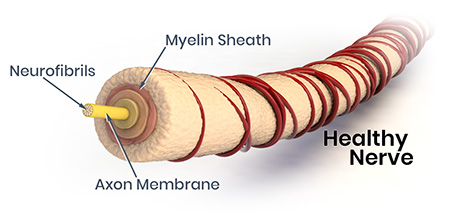 Neuropathy Nerve Damage